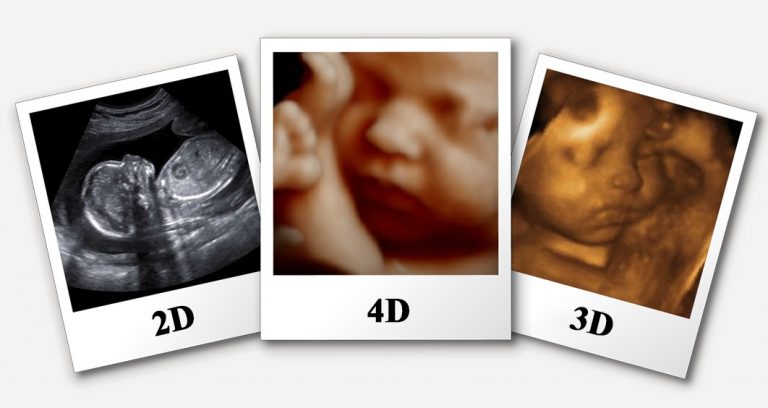 ultrasound image capture